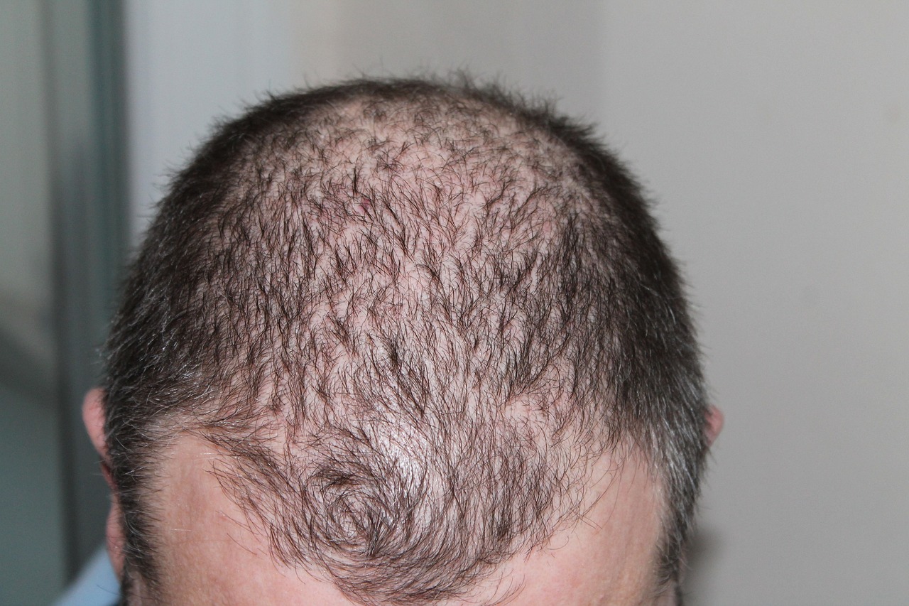 Does mushroom cause hair loss? (Hair Loss Unmasked)